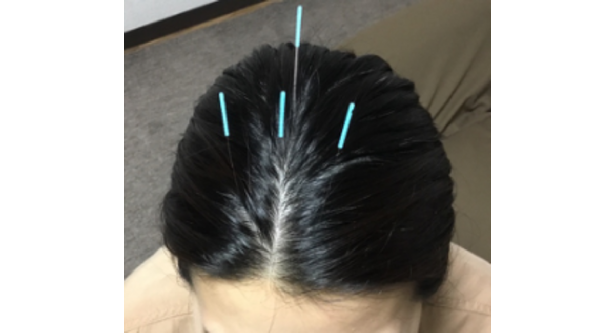 頭皮鍼